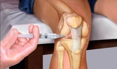 Ácido hialurónico con artrose da articulación do xeonllo