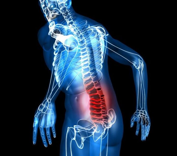 etapas de grao e desenvolvemento da osteocondrose lumbar