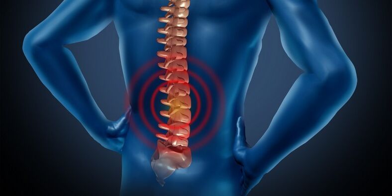 Osteocondrose da rexión lumbar