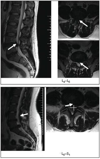 Imaxe de resonancia magnética dun disco herniado na columna vertebral