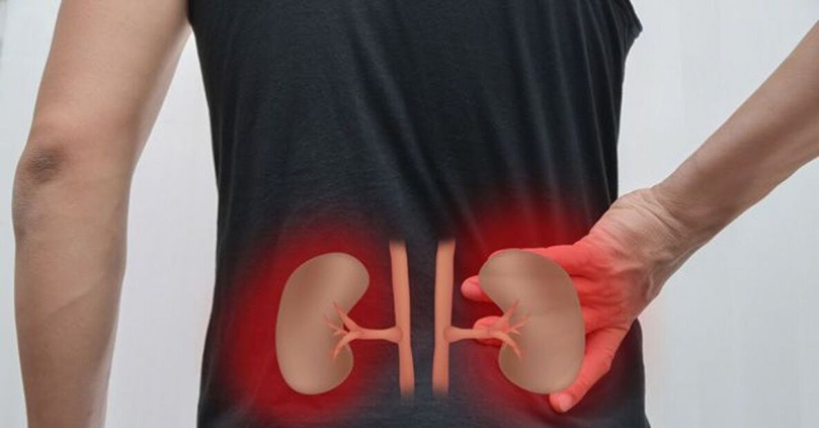 A inflamación dos riles pode causar dor lumbar