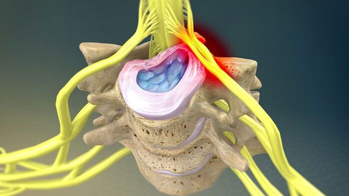 A protrusión do disco intervertebral provoca dor no pescozo