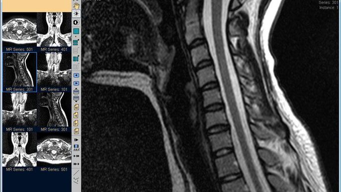 A resonancia magnética da columna cervical é o mellor método para diagnosticar a dor no pescozo